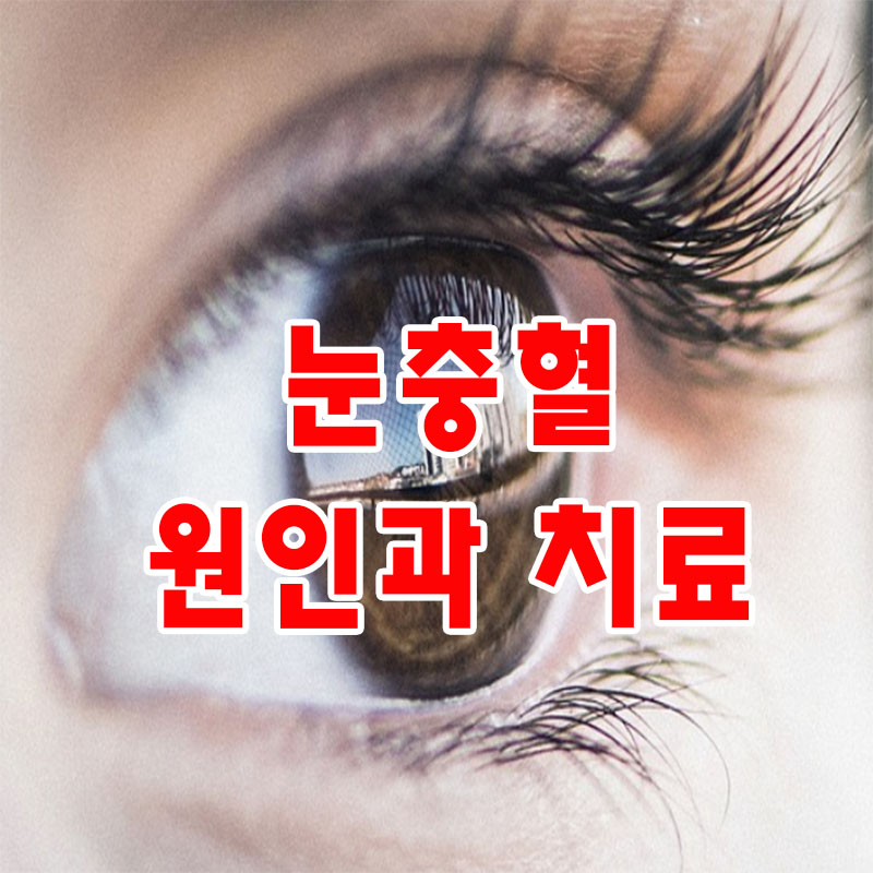 눈병
