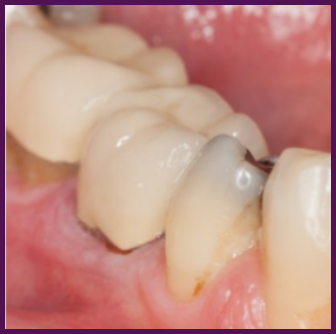 정릉동치과 추천 29년 경력 대표원장 과잉진료 없는 곳 임플란트 전 자연치아 살리기 치료 잘하는 치과 선택 기준