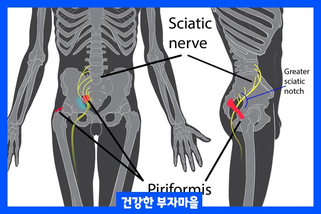 요추 척추관 협착층, 감염, 종양 등이 원인