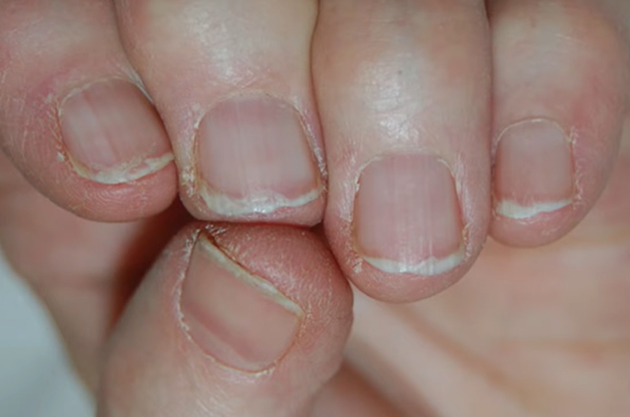 손톱이 잘 부러지는 이유