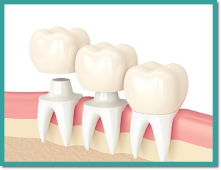 치과 크라운 종류