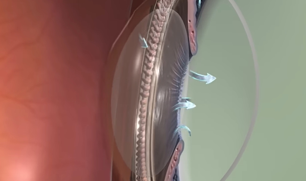 녹내장 초기증상