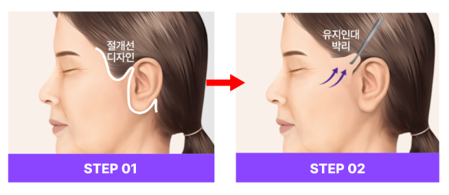 강남역성형외과 스마일거상 수술방법