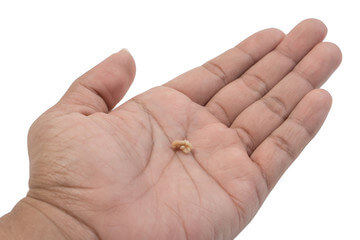 편도결석 빼는법&amp;#44; 집에서 빼는법 및 예방법을 알아봤습니다. 집에서 편도결석 빼는법과 병원에서는 편도결석을 어떻게 제거하는지 참고하시기 바랍니다. 