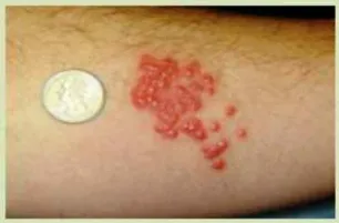 빈대 퇴치제 빈대 물린 자국