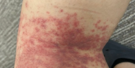 글루타민의 효능 효과와 L -글루타민 그리고 글루타민의 부작용