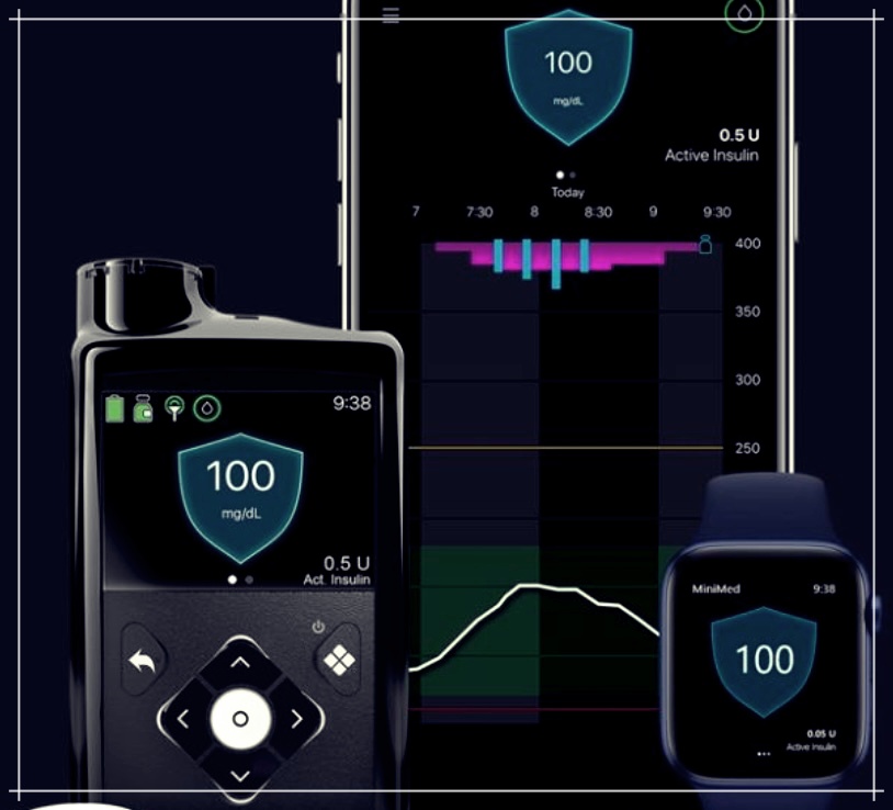 인슐린 펌프: 가격, 종류 및 시술 병원