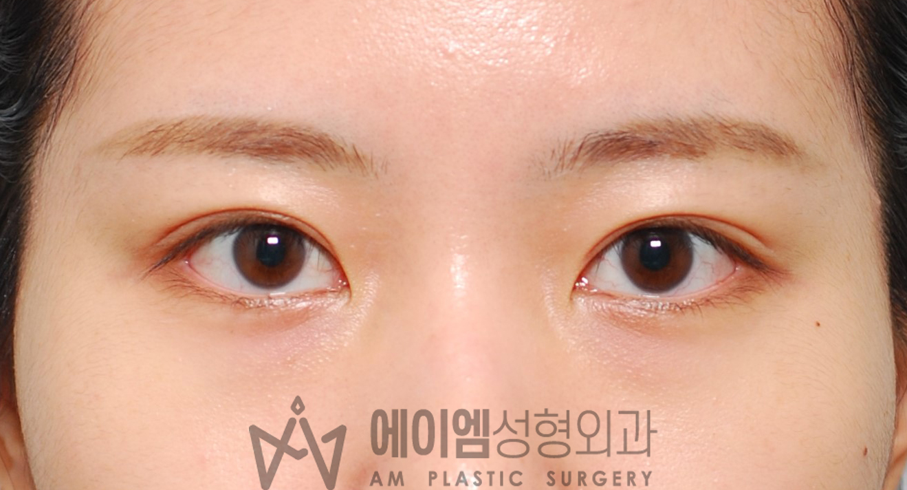 쌍수 붓기 4개월 (절개법)