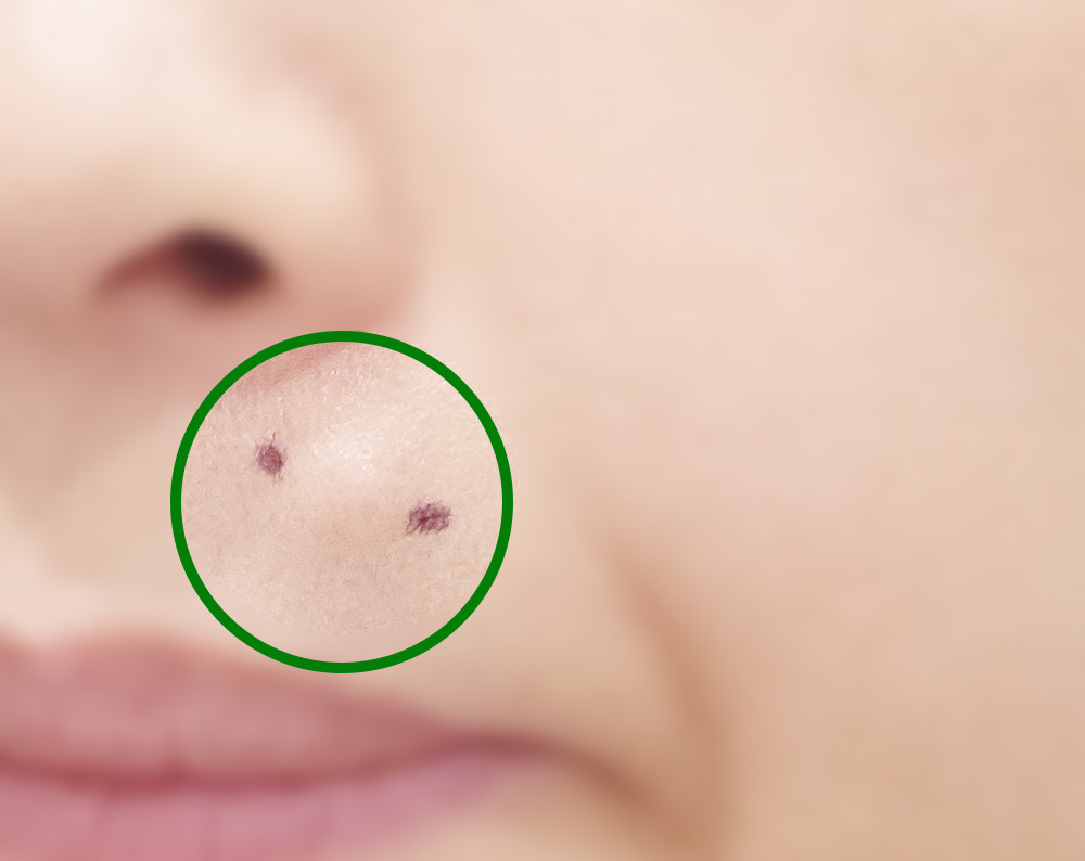 얼굴 피지낭종 제거 후기