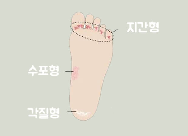 무좀 형태
