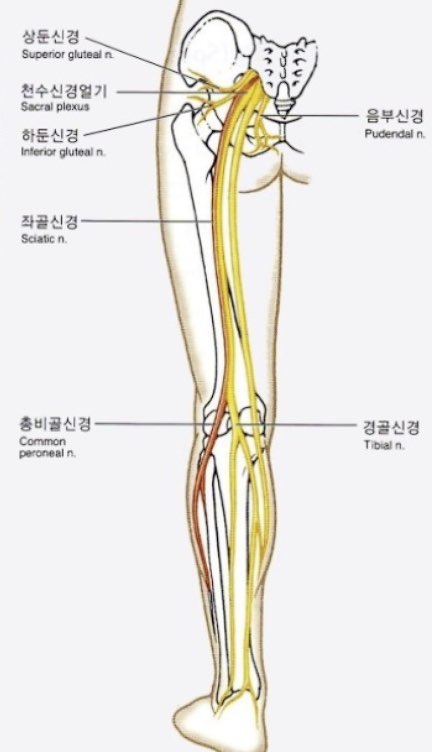 좌골신경통의 원인과 특징 및 효과적인 치료법에 대한 사진
