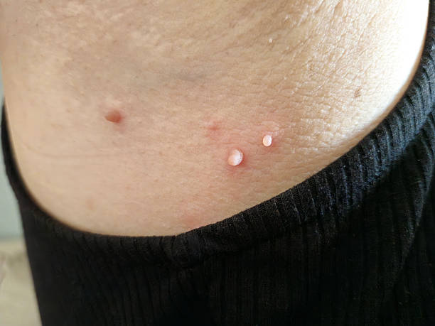 목에 쥐젖이 생기는 주요 원인