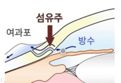 녹내장 수술 섬유주절제술