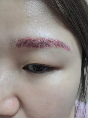 눈썹 문신 제거 방법 꿀팁_2