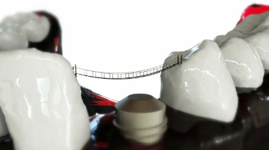 임플란트 가격에 영향을 미치는 요소