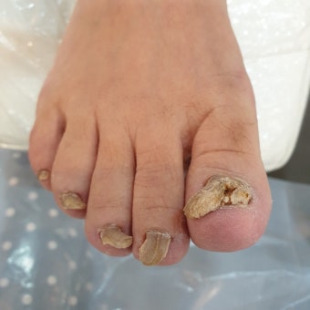 발톱 색 변색의 5가지 주요 원인