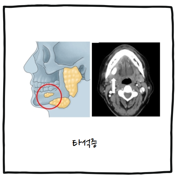 타석증