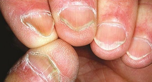 손톱 조갑 박리증