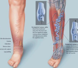 하지정맥류-수술비용