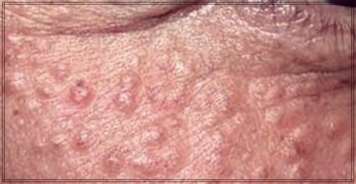 한관종 제거 후기: 내 경험을 공유합니다