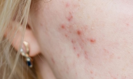 여드름 원인 및 종류