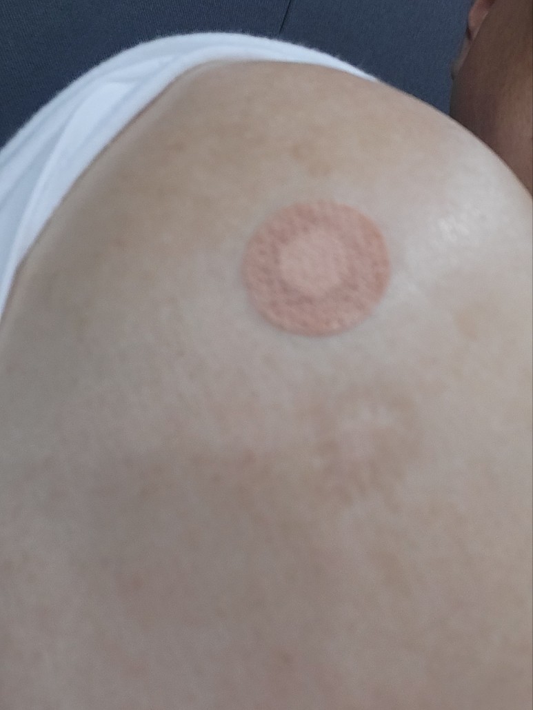 주사 맞은 자리 사진