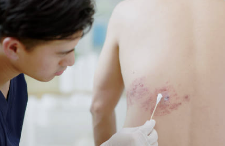 대상포진 예방접종 가격(최저가) 초기증상 치료방법 총정리