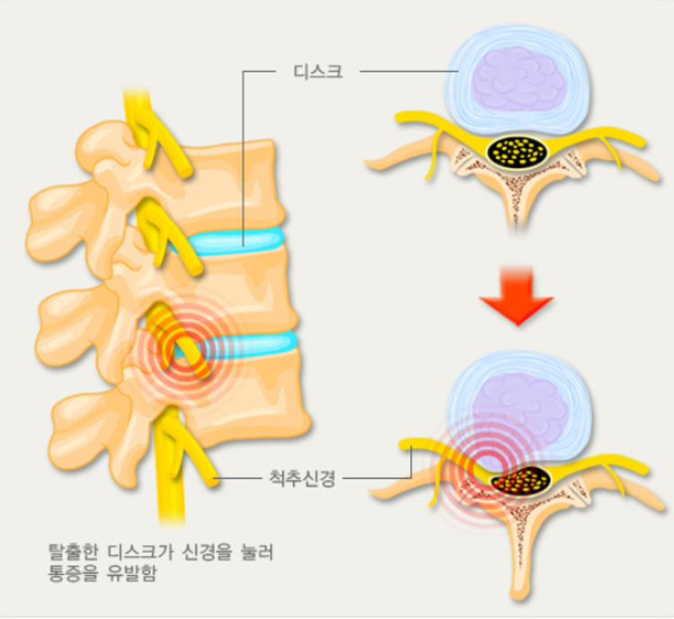 좌골신경통 증상