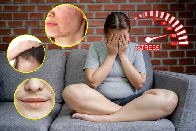 다낭성난소증후군 증상 자가진단 우울증 불안장애 여자 살찌는병