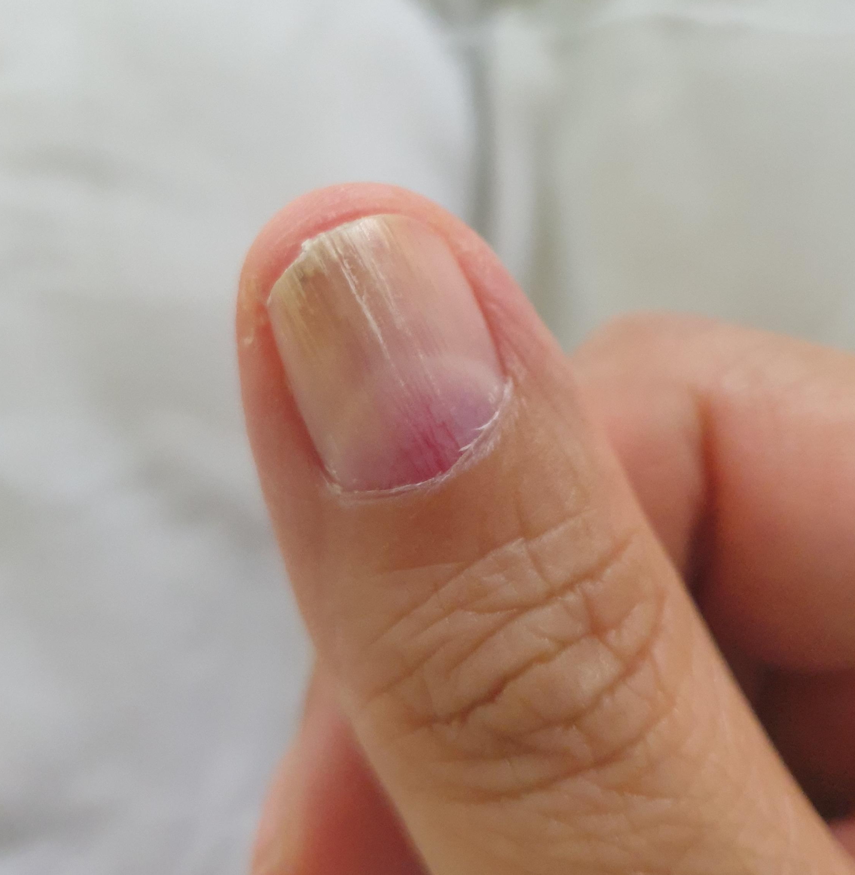 손톱밑통증 사진(오)