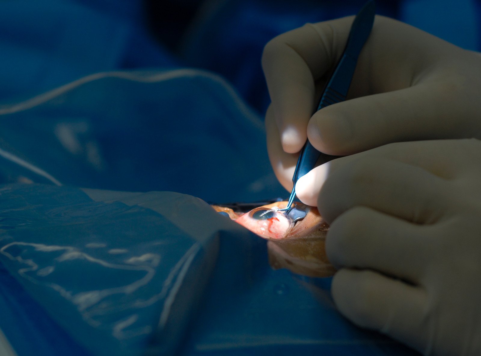 공막동률술 (Scleral Buckling Surgery)