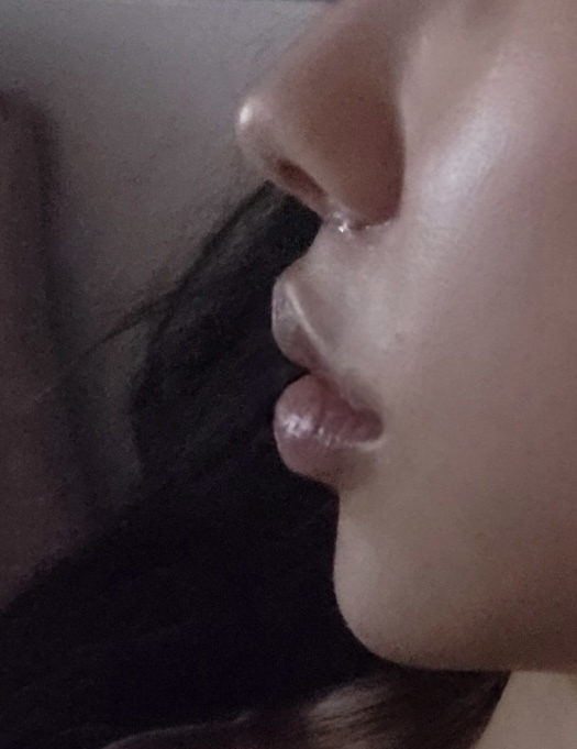 인중 축소 수술 후기