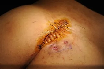 엉덩이 종기가 생기는 이유 왜 생기고 어떻게 관리할까요 완벽 가이드_22