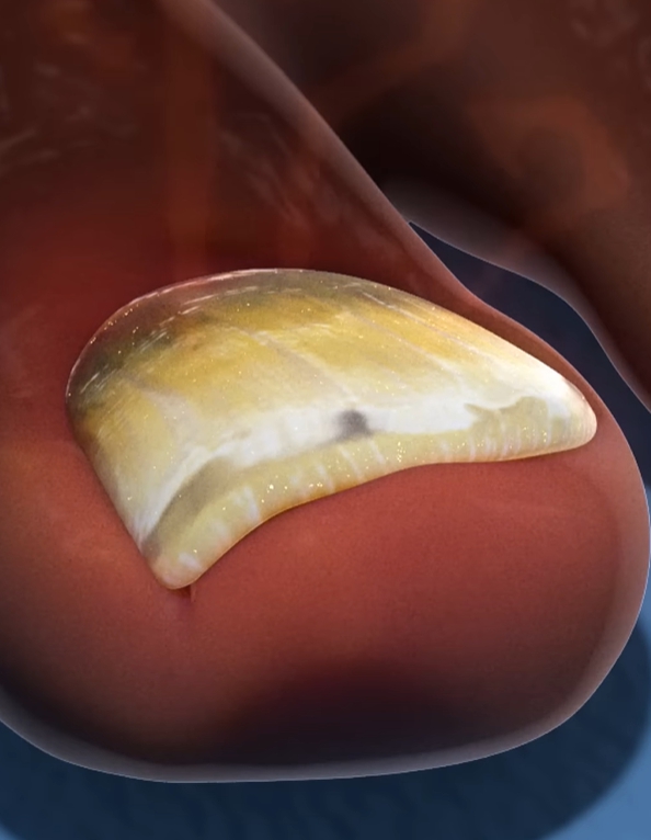 발톱이 검게 변하는 이유