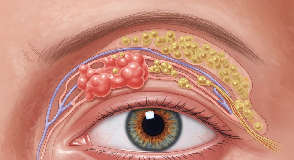 눈 다래끼 빨리 낫는 법 효과 빠른 방법 총정리
