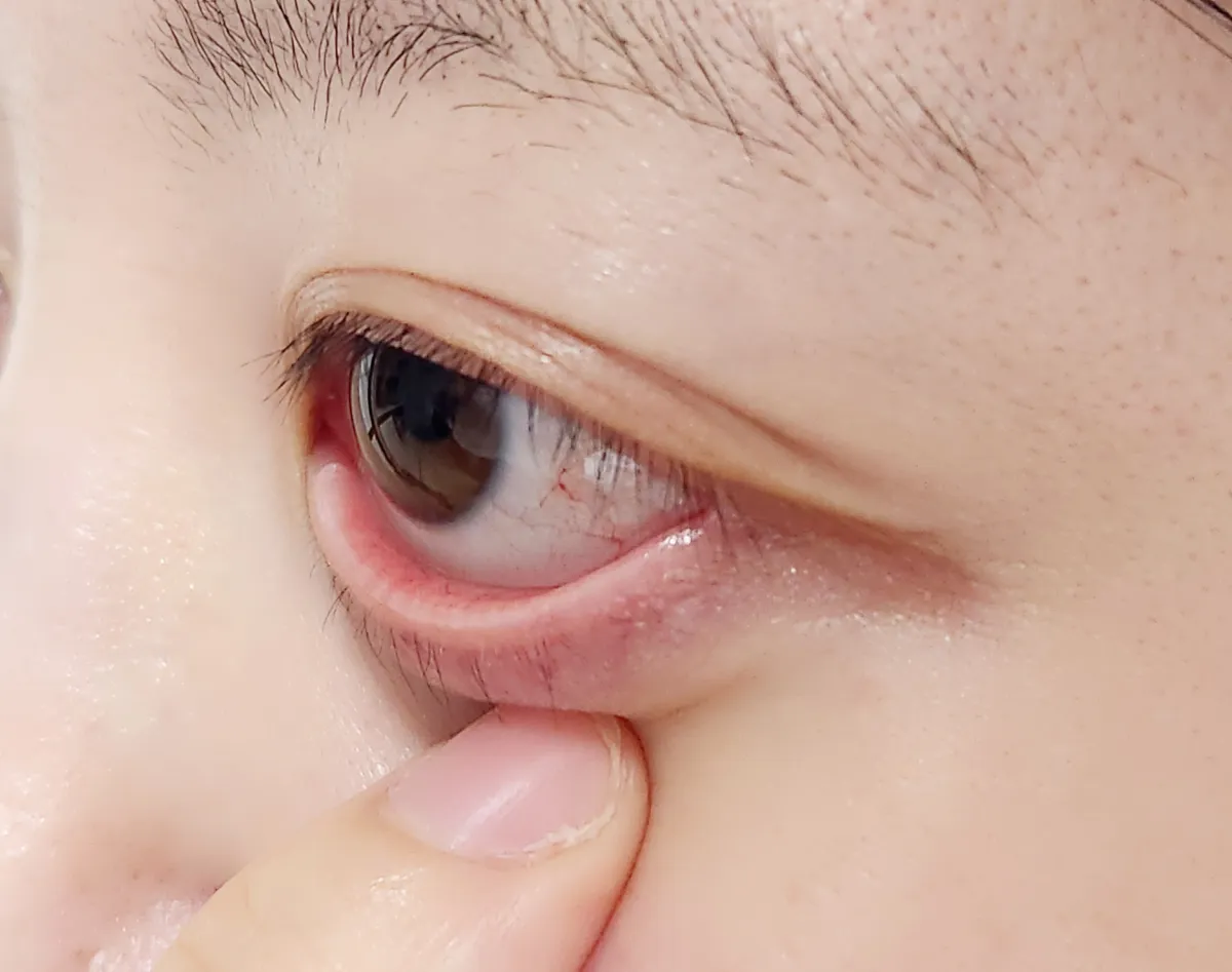 눈점막과-속눈썹-사이에-마이봄샘