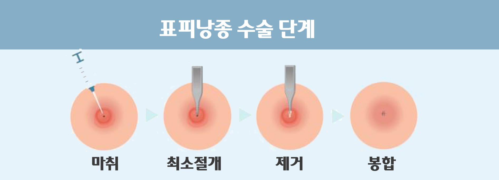 피부 혹 멍울 피지낭종