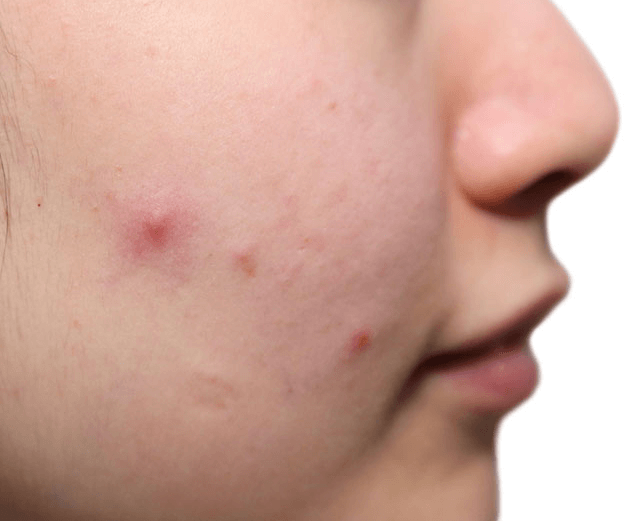 화농성 여드름 사진