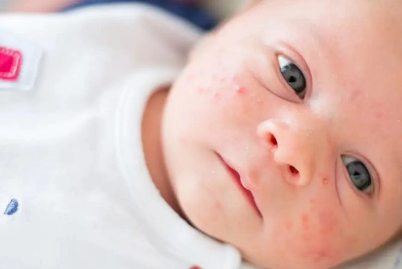 신생아 뾰루지 원인