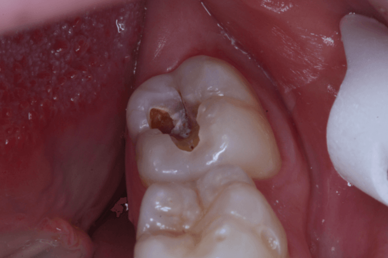 어금니 충치 깨짐 원인