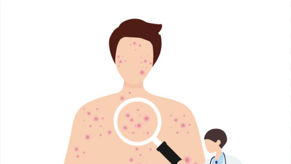 엠폭스-증상사진-감염경로