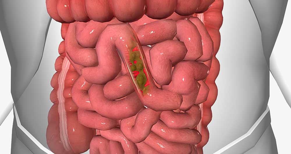 변비에 안 좋은 음식