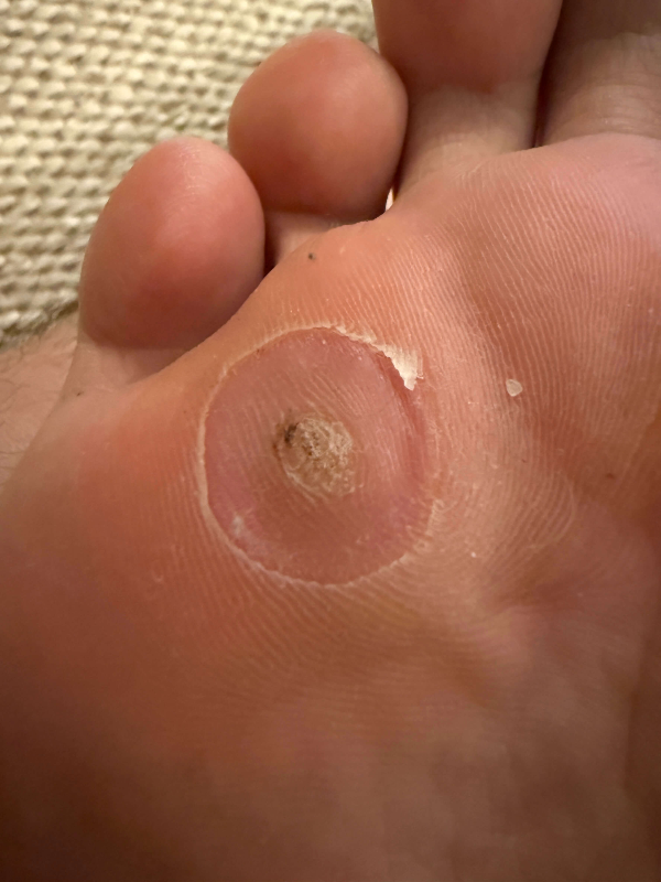 족저사마귀-사진