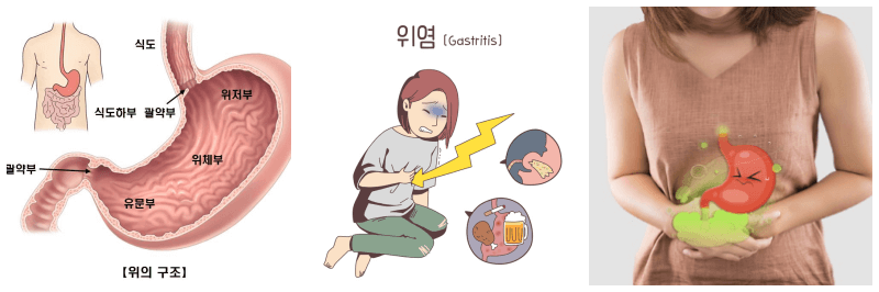 위 구조, 위염, 배 아픈 사람 사진