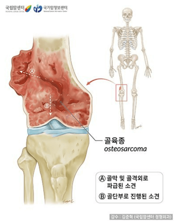 골육종