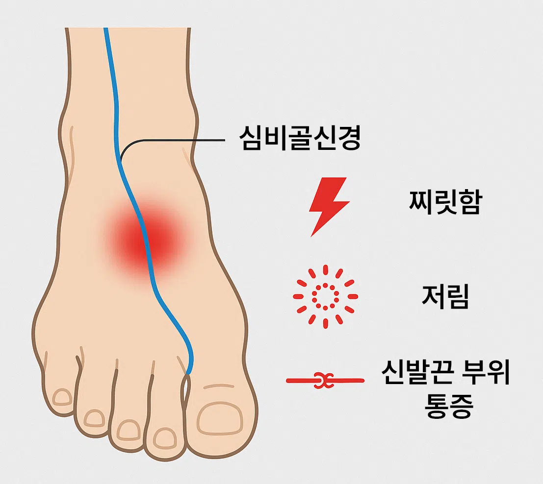 신경포착증후군