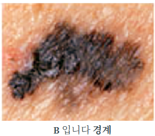 흑색종