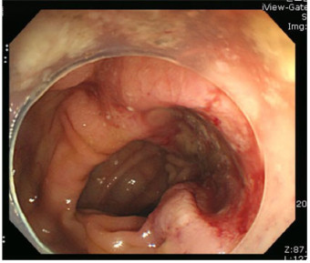대장암 초기증상 혈변 원인