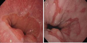 역류성식도염증상