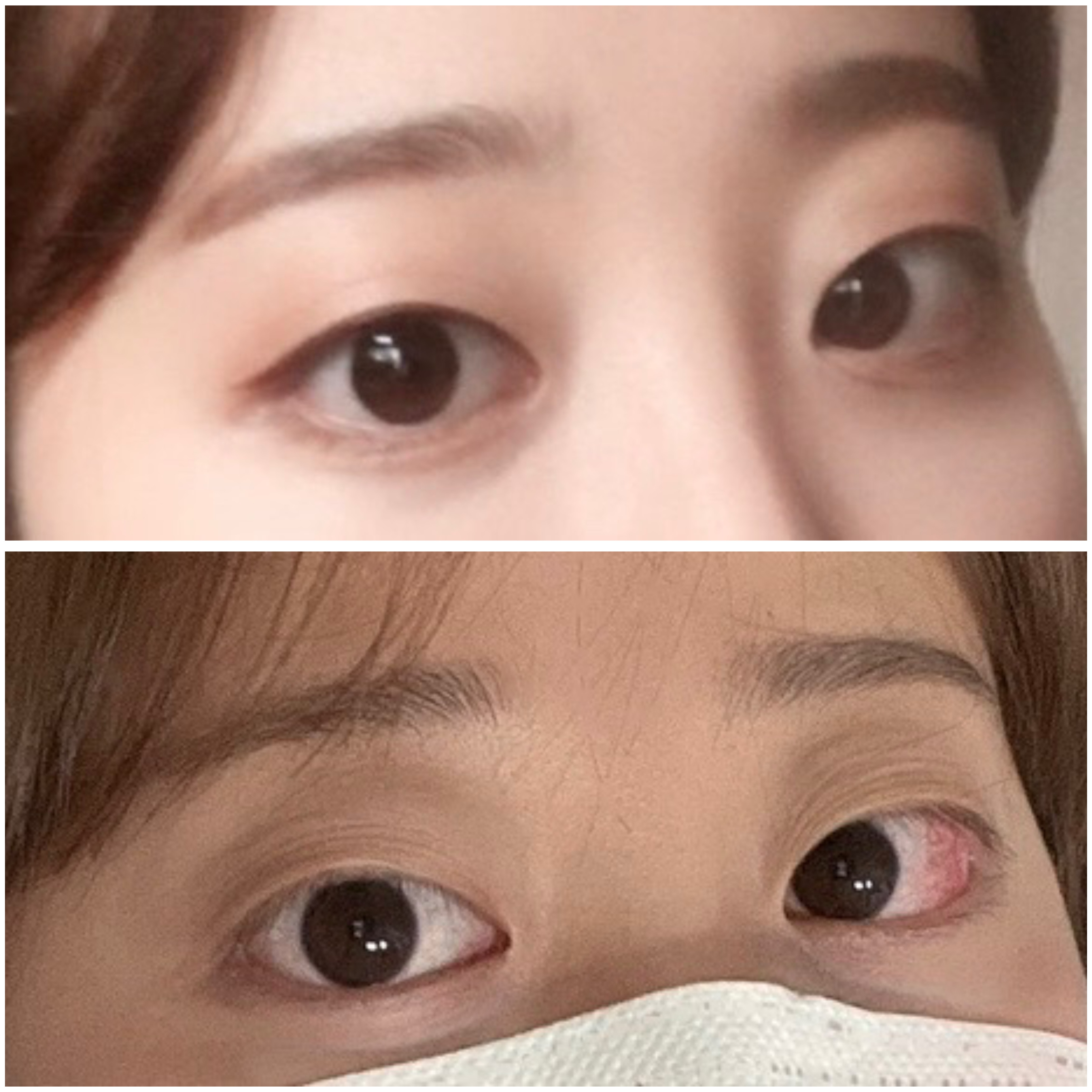 갑상선안병증 전,후 사진